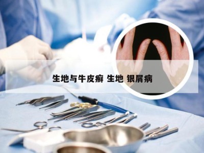 生地与牛皮癣 生地 银屑病