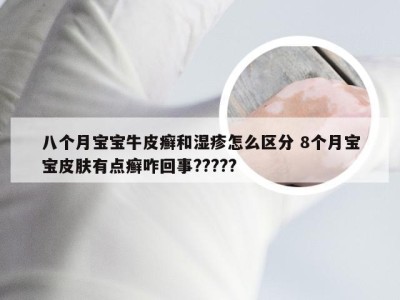 八个月宝宝牛皮癣和湿疹怎么区分 8个月宝宝皮肤有点癣咋回事?????
