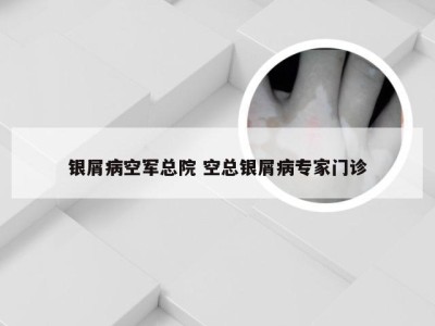 银屑病空军总院 空总银屑病专家门诊