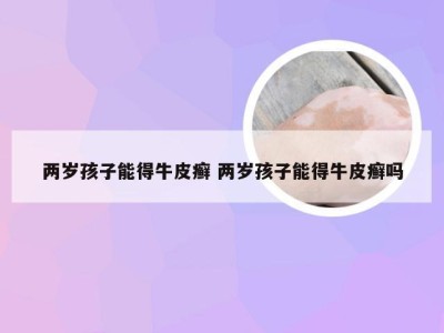 两岁孩子能得牛皮癣 两岁孩子能得牛皮癣吗