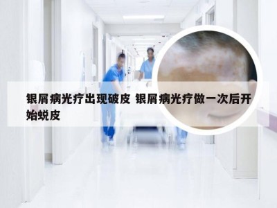 银屑病光疗出现破皮 银屑病光疗做一次后开始蜕皮