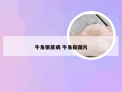 牛角银屑病 牛角藓图片