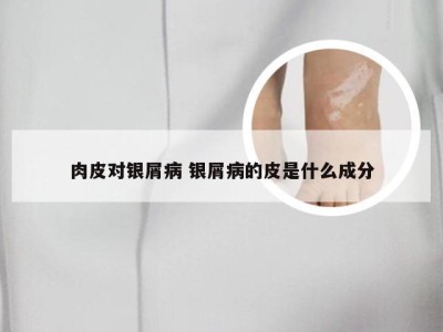 肉皮对银屑病 银屑病的皮是什么成分