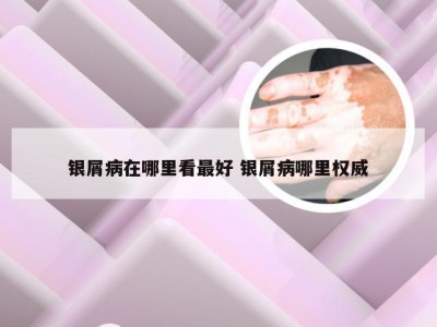 银屑病在哪里看最好 银屑病哪里权威
