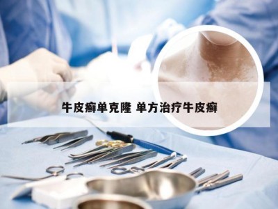 牛皮癣单克隆 单方治疗牛皮癣