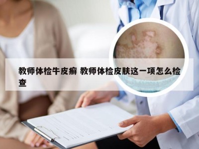 教师体检牛皮癣 教师体检皮肤这一项怎么检查