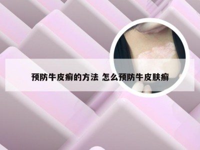 预防牛皮癣的方法 怎么预防牛皮肤癣