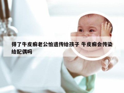得了牛皮癣老公怕遗传给孩子 牛皮癣会传染给配偶吗