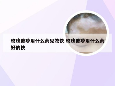 玫瑰糠疹用什么药见效快 玫瑰糠疹用什么药好的快