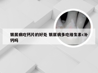 银屑病吃钙片的好处 银屑病多吃维生素c补钙吗