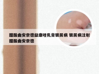 醋酸曲安奈德益康唑乳膏银屑病 银屑病注射醋酸曲安奈德
