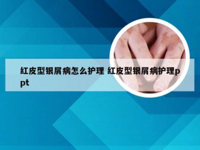 红皮型银屑病怎么护理 红皮型银屑病护理ppt