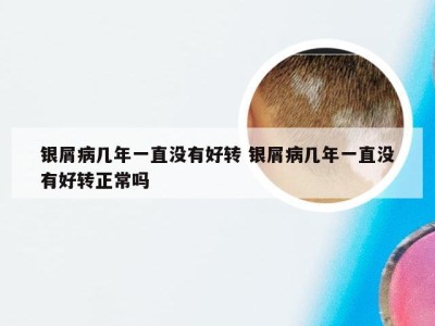 银屑病几年一直没有好转 银屑病几年一直没有好转正常吗