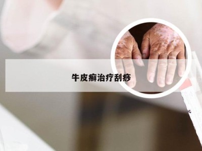 牛皮癣治疗刮痧