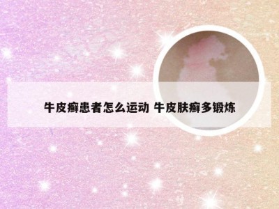 牛皮癣患者怎么运动 牛皮肤癣多锻炼