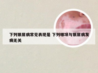 下列银屑病常见表现是 下列哪项与银屑病发病无关