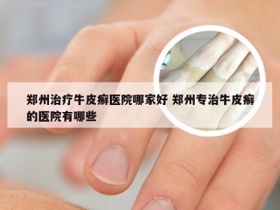 郑州治疗牛皮癣医院哪家好 郑州专治牛皮癣的医院有哪些