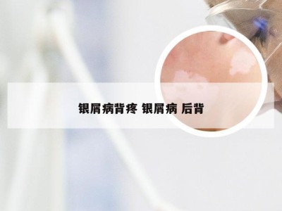 银屑病背疼 银屑病 后背