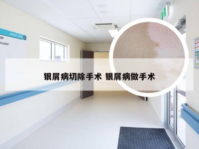 银屑病切除手术 银屑病做手术