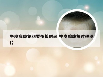 牛皮癣康复期要多长时间 牛皮癣康复过程图片