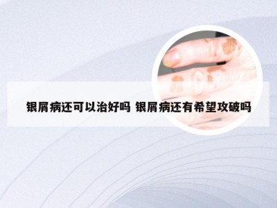银屑病还可以治好吗 银屑病还有希望攻破吗