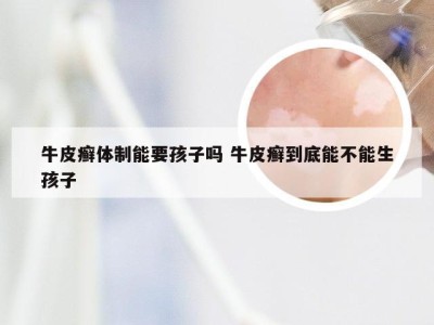 牛皮癣体制能要孩子吗 牛皮癣到底能不能生孩子