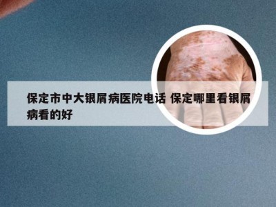 保定市中大银屑病医院电话 保定哪里看银屑病看的好