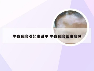牛皮癣会引起脚趾甲 牛皮癣会长脚底吗