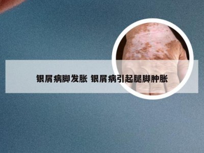 银屑病脚发胀 银屑病引起腿脚肿胀