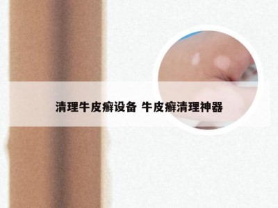 清理牛皮癣设备 牛皮癣清理神器