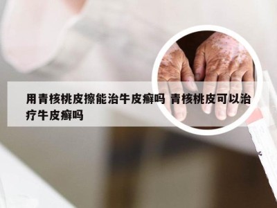 用青核桃皮擦能治牛皮癣吗 青核桃皮可以治疗牛皮癣吗