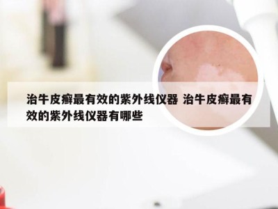 治牛皮癣最有效的紫外线仪器 治牛皮癣最有效的紫外线仪器有哪些