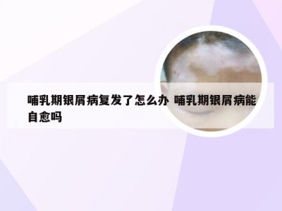 哺乳期银屑病复发了怎么办 哺乳期银屑病能自愈吗
