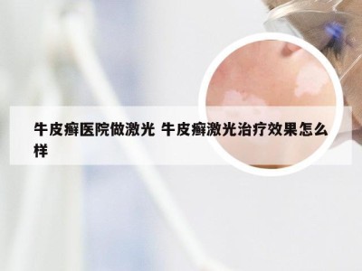 牛皮癣医院做激光 牛皮癣激光治疗效果怎么样