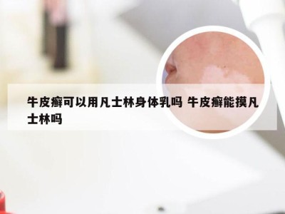 牛皮癣可以用凡士林身体乳吗 牛皮癣能摸凡士林吗