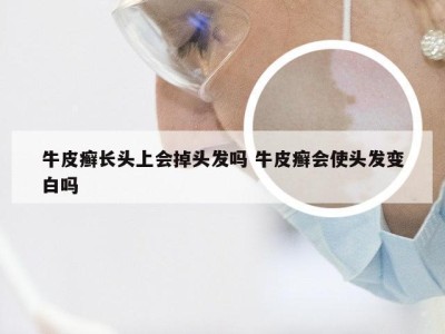 牛皮癣长头上会掉头发吗 牛皮癣会使头发变白吗