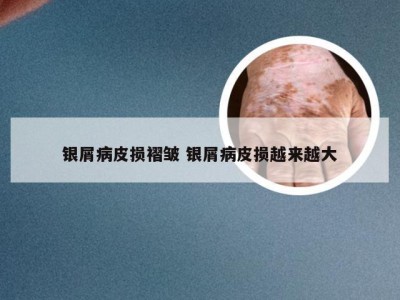 银屑病皮损褶皱 银屑病皮损越来越大