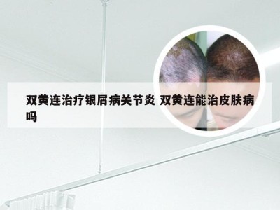双黄连治疗银屑病关节炎 双黄连能治皮肤病吗