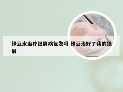 绿豆水治疗银屑病复发吗 绿豆治好了我的银屑