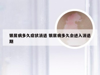 银屑病多久症状消退 银屑病多久会进入消退期