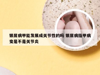 银屑病甲能发展成关节性的吗 银屑病指甲病变是不是关节炎