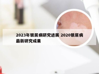 2023年银屑病研究进展 2020银屑病最新研究成果