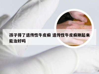 孩子得了遗传性牛皮癣 遗传性牛皮癣刚起来能治好吗