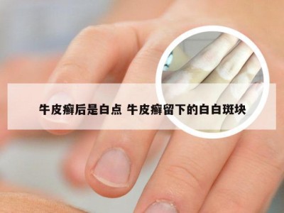 牛皮癣后是白点 牛皮癣留下的白白斑块