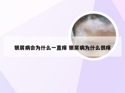 银屑病会为什么一直痒 银屑病为什么很痒