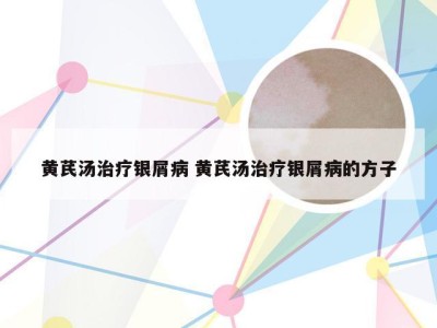 黄芪汤治疗银屑病 黄芪汤治疗银屑病的方子