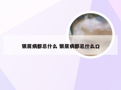 银屑病都忌什么 银屑病都忌什么口