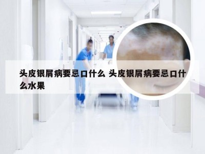 头皮银屑病要忌口什么 头皮银屑病要忌口什么水果