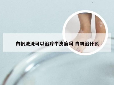 白帆洗洗可以治疗牛皮癣吗 白帆治什么