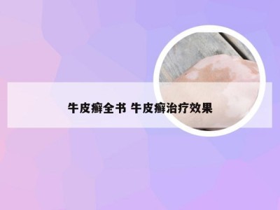牛皮癣全书 牛皮癣治疗效果
